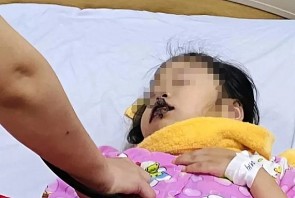 Nuốt nhầm xút ăn da, bé gái 5 tuổi nhập viện cấp cứu vì cháy khoang miệng