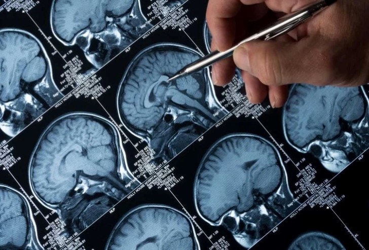 Ứng dụng AI để xác định bệnh u não ác tính với độ tin cậy cực cao
