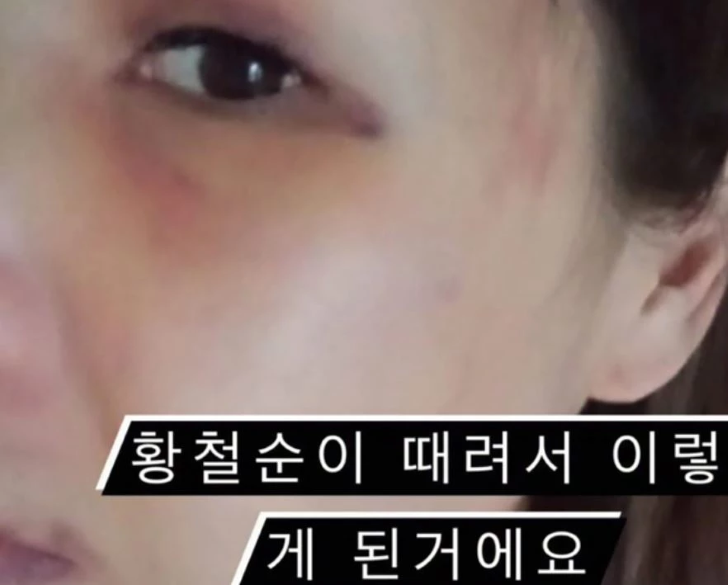 Truy tố vận động viên thể hình Hàn Quốc 8 múi đánh bạn gái gãy xương